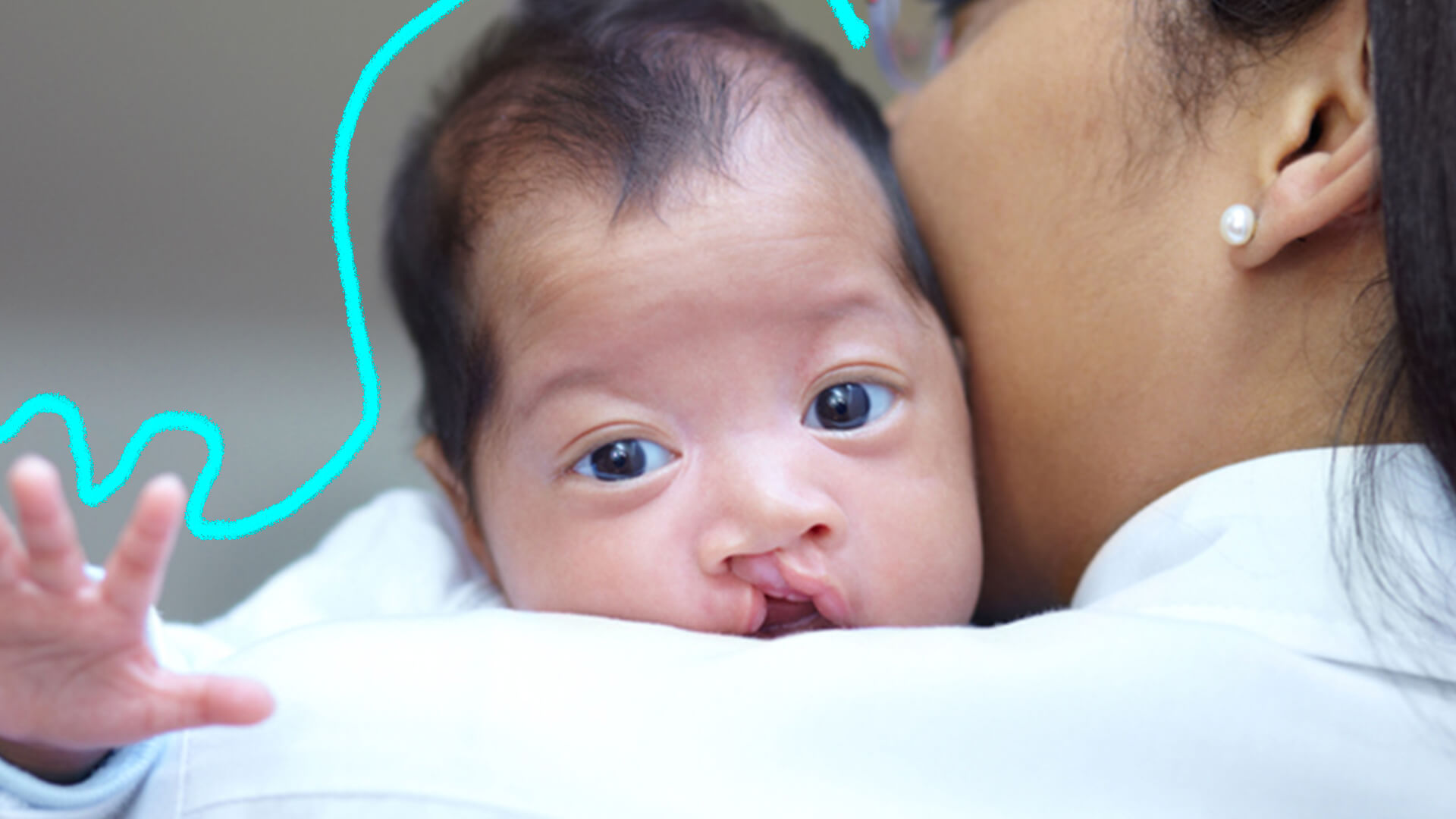 Fissuras faciais: foto de uma mulher com bebê com lábio leporino abraçado ao ombro.