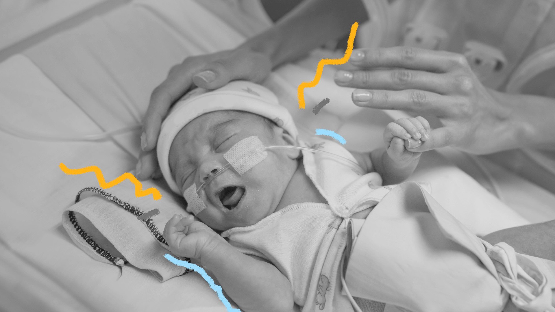 Foto em preto e branco de um bebê prematuro, chorando.